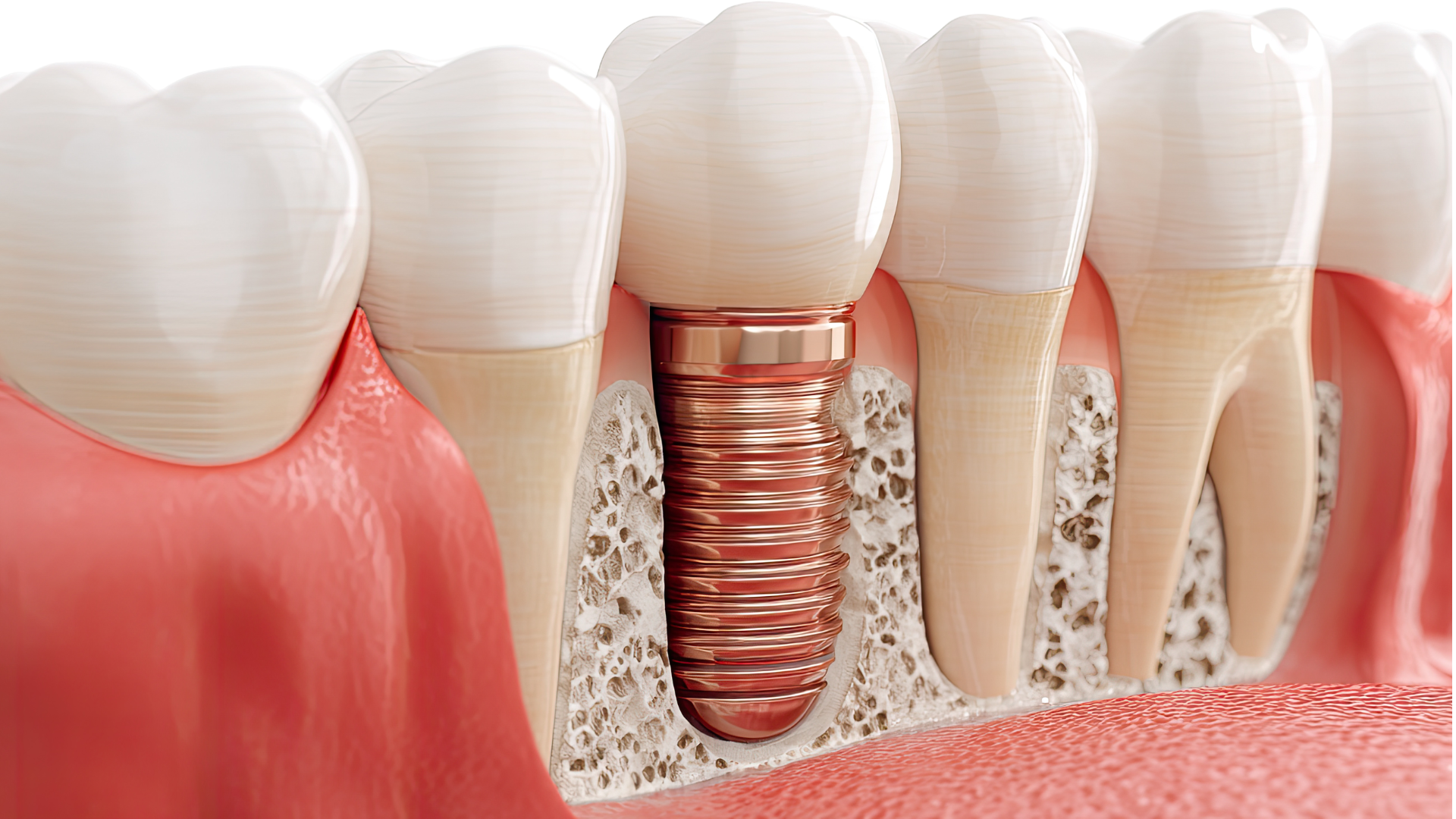 Dental implant illustration
