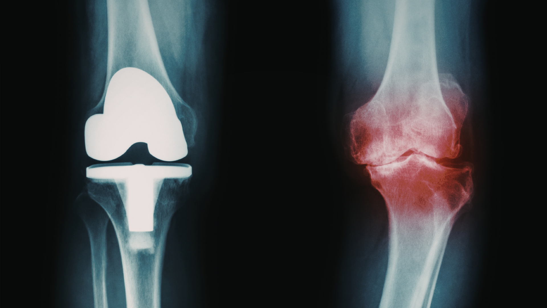 Knee replacement X-ray